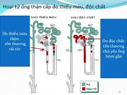 Hoại tử ống thận cấp - Hình ảnh minh họa